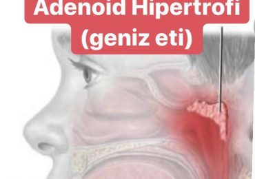 Adenoid Hipertrofi (Geniz Eti)