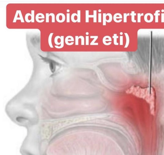 Adenoid Hipertrofi (Geniz Eti)